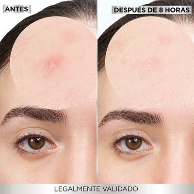 Antes y después pimple patch Garnier